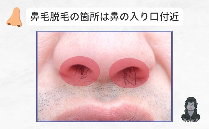 3. レーザー脱毛