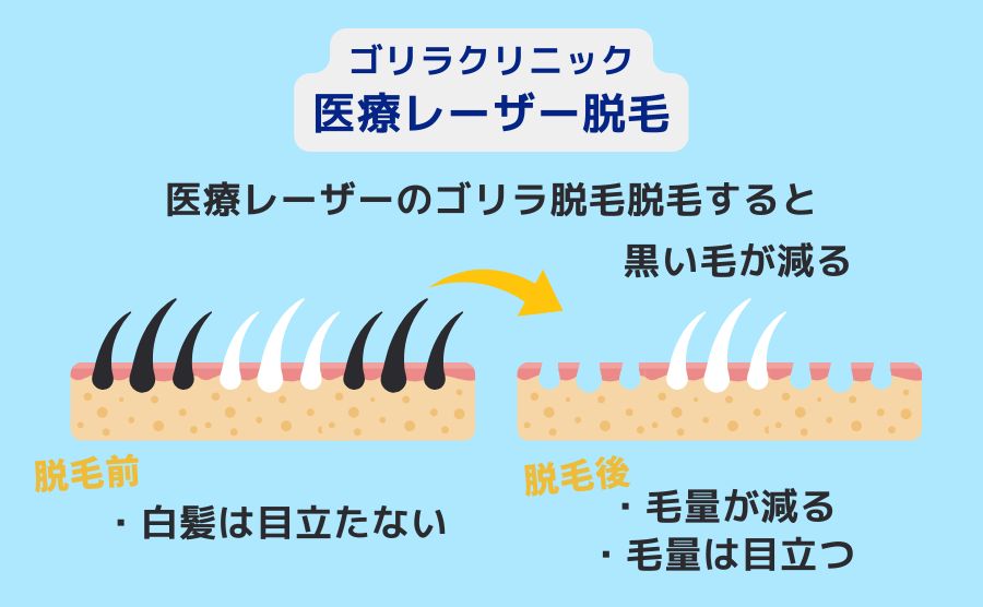 ゴリラ脱毛白髪