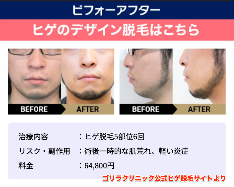 ゴリラクリニックのヒゲ脱毛デザイン