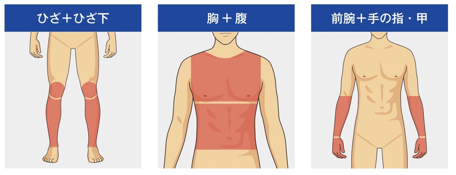 ゴリラクリニック夏キャンペーンの部位