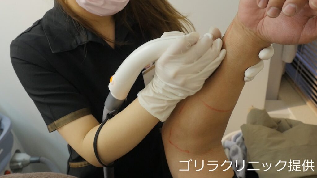 ゴリラクリニックのボディ脱毛