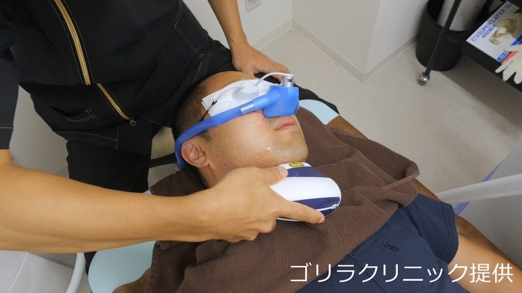 蓄熱式のヒゲ脱毛施術