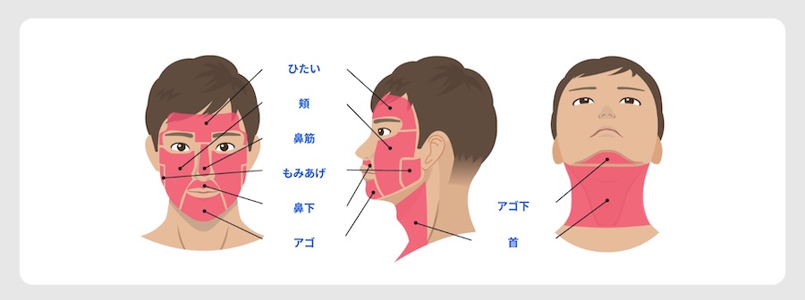 レジーナクリニックオムのヒゲ脱毛